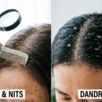 Lice or Dandruff